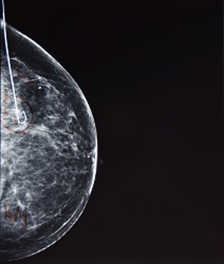 Core Needle Biopsy Hormone Receptor Testing For Breast Cancer Wastes Millions of Dollars