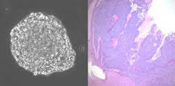 Left: Neural stem cells transformed with cancer-causing genes found in high-risk medulloblastoma grow as translucent spheres in cell culture (magnification = 200X). Right: Low magnification view of transformed neural stem cells (blue) invading and destroying normal brain tissue (pink) in mice. (Credit: Allison Hanaford and Eric Raabe)