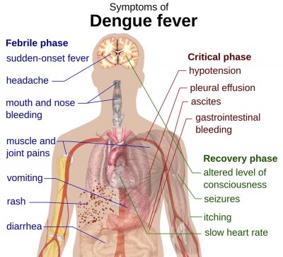 Dengue Vaccine Could Increase Or Worsen Dengue in Some Settings