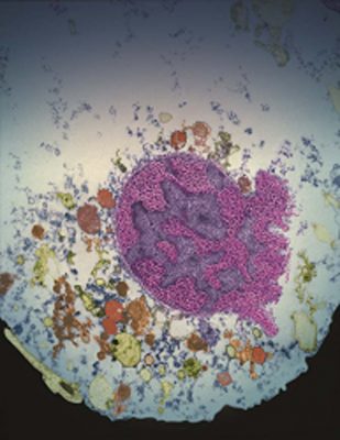 Nucleus of a cell undergoing parthanatos. (credit: Yingfei Wang and I-Hsun Wu/Johns Hopkins Medicine)