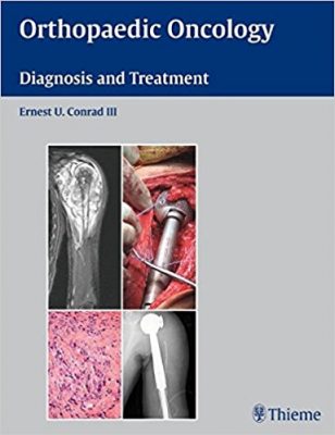 orthopaedic-oncology-diagnosis-and-treatment