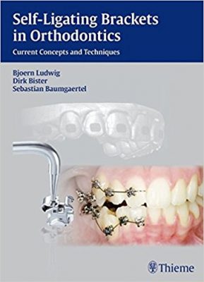 self-ligating-brackets-in-orthodontics
